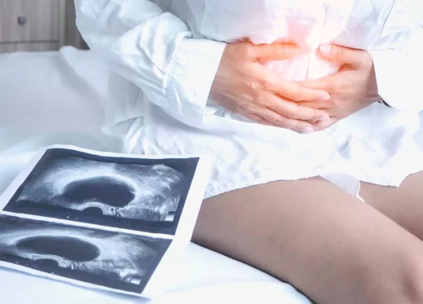 La chirurgie de l’endométriose, une chirurgie minutieuse.